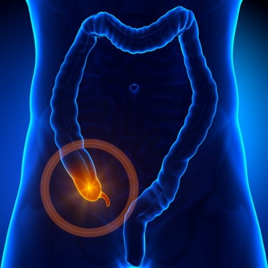 Image of an inflamed appendix.